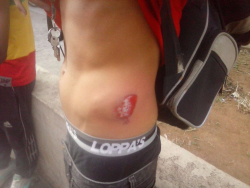 Manifestante mostra ferimento causado por policiais militares em Nova Lima